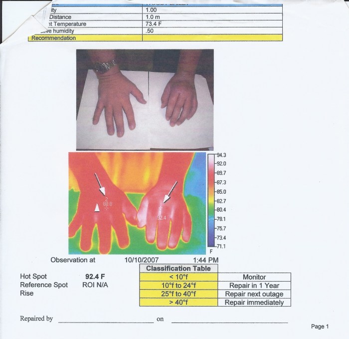 Hands with CRPS  thermal imaging