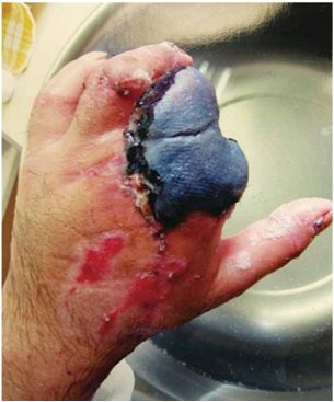 Figure 1 Free Flap - Photograph taken by the patient showing a pedicled reverse forearm flap that totally failed to cover the stumps