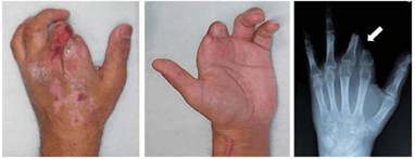 Figure 2 (a, b) Photographs showing the condition at presentation. The stumps of the fingers were almost dry with cicatricial tissue. The patient reported severe pain expanding over the region of the upper arm. (c) Preoperative radiograph showing malposition of the proximal phalanx of the index and middle fingers (arrow) caused by severe scar contracture around the two stumps.