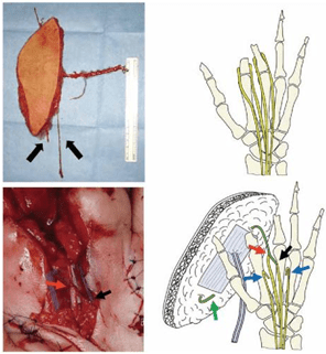 (a) A free anterolateral thigh flap (7 x 23 cm) was designed and harvested with its cutaneous nerve (arrows). (b) Schematic diagram of the digital nerves. (c) Intraoperative photo showing end-to-end (black arrow) and end-to-side (red arrow) neurorrhaphy between the digital nerves and cutaneous nerve of the flap. (d) Schematic diagram of the procedure. After releasing the contracture between the two stumps, the digital nerves between them are coapted to the cutaneous nerve of the flap using end-to-end (black arrow) and end-to-side (red arrow) neurorrhaphy. The other end of the cutaneous nerve of the flap is buried deeply in the soft tissue (green arrow). The other digital nerves are refreshed for about 3 cm and buried deeply in the muscle (blue arrows).