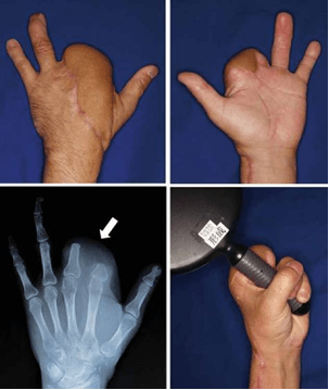 Figure 4. (a, b) Photographs and radiograph at 18 months postopera-tively. The skin paddle of the flap was set to divide and cover the two stumps and dorsum of the hand. Almost all pain had disappeared at 18 months postoperatively. (c) Postoperative radiograph shows good alignment of the two stumps (arrow). (d) Range of motion, including that of the other fingers, substantially recovered. The patient can now grasp things easily without pain and enjoys motorbike riding.