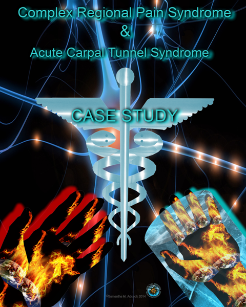 CRPS RSD & Acute Carpal Tunnel Syndrome