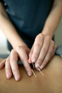 Woman receiving acupuncture
