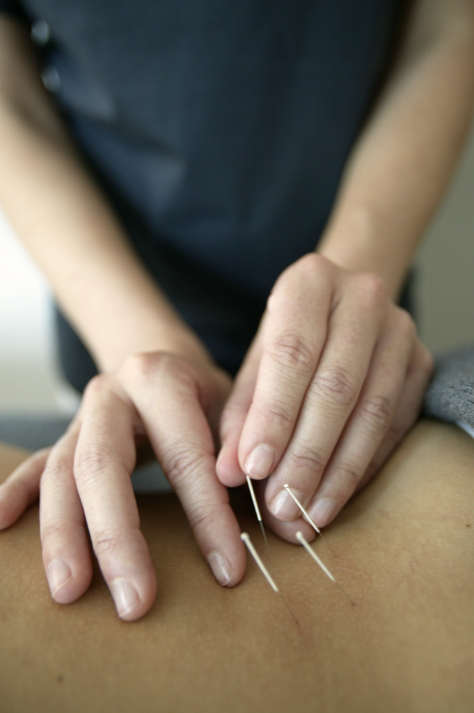 Acupuncture as Part of a Pediatric Pain Clinic in a Safety-Net Hospital: Acupuncture&nbsp;Wednesday
