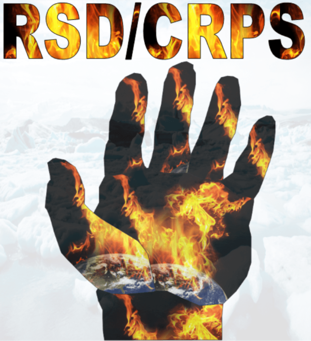 Complex regional pain syndrome in a young&nbsp;female